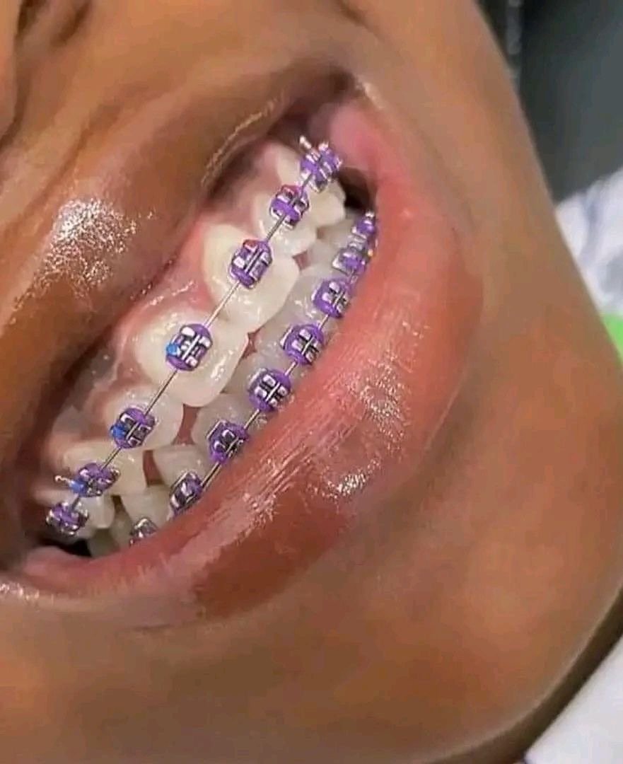 FASHION BRACES - ORING