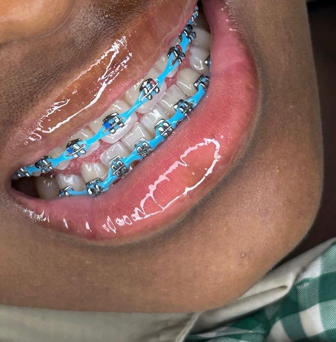FASHION BRACES- POWERCHAIN